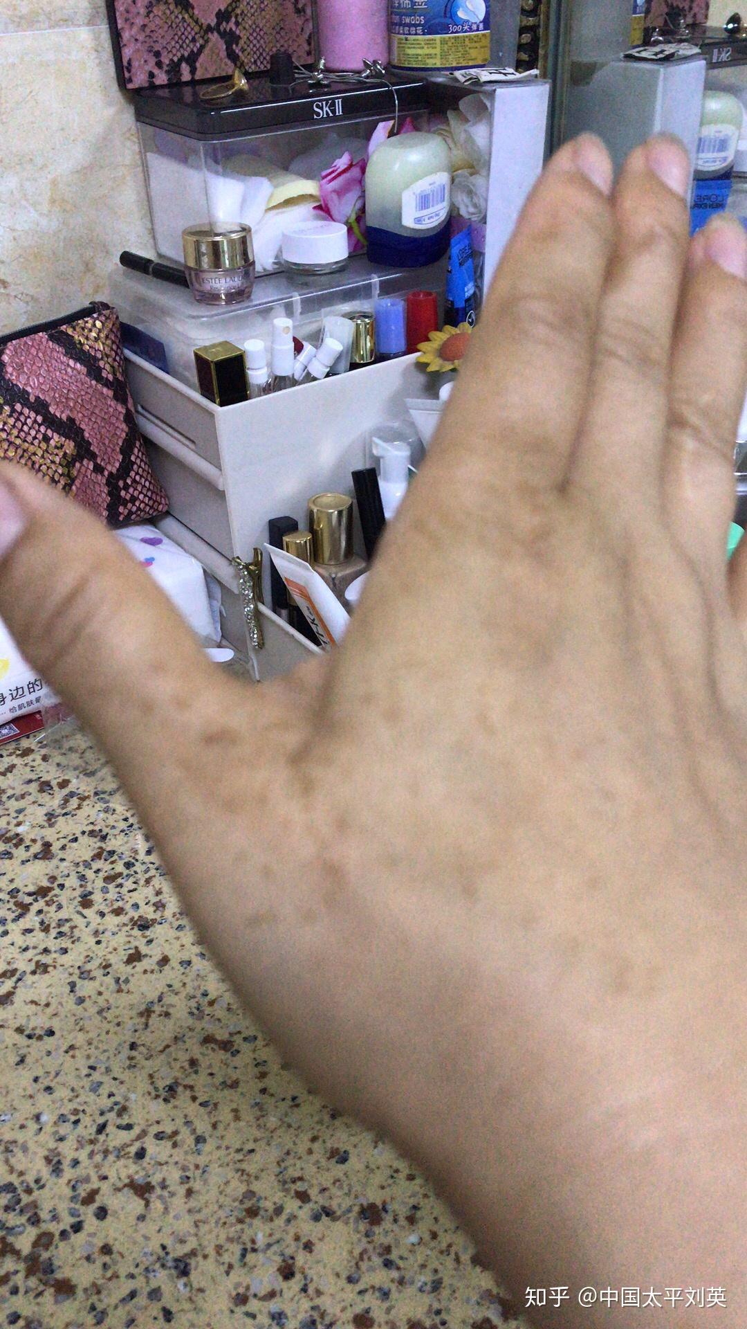 手上长了一些像斑一样的东西到底是什么呢