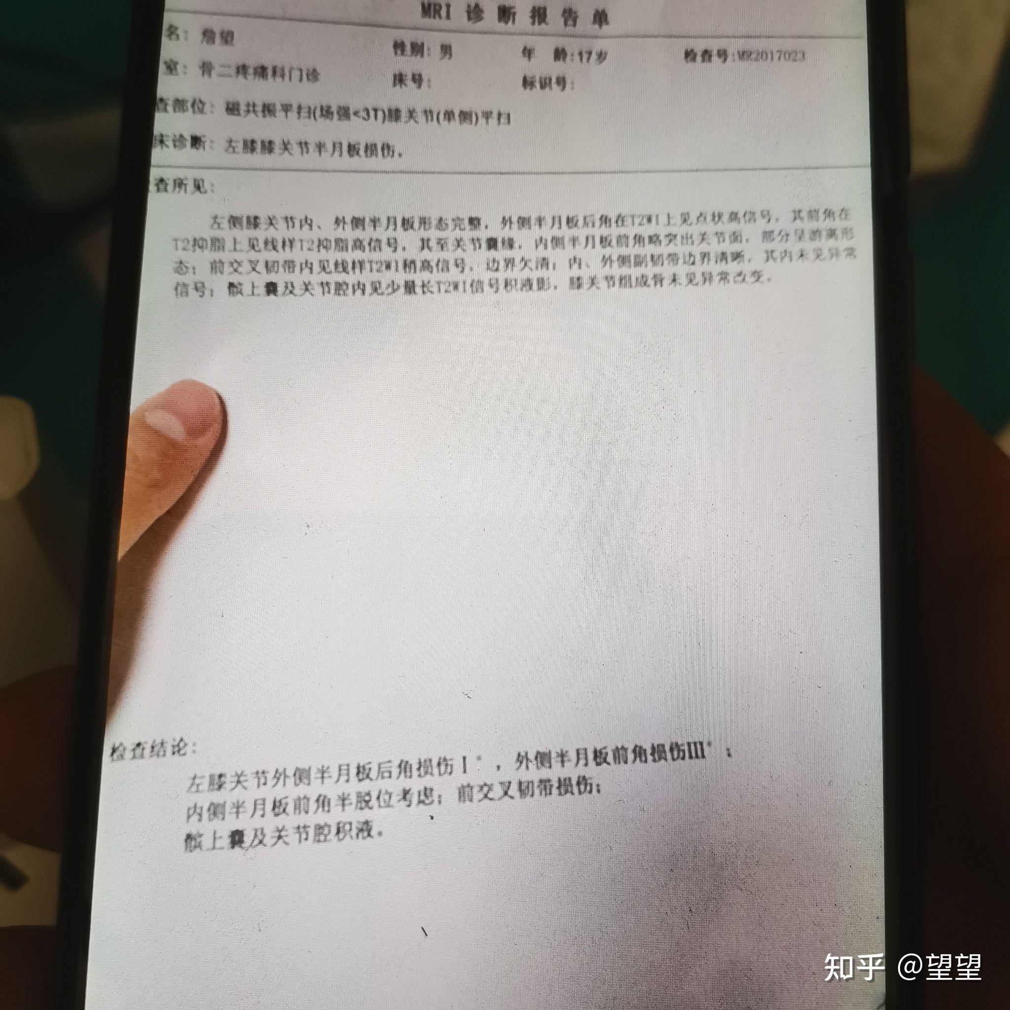 半月板撕裂患者手術後經過多年恢復適合進行深蹲運動嗎