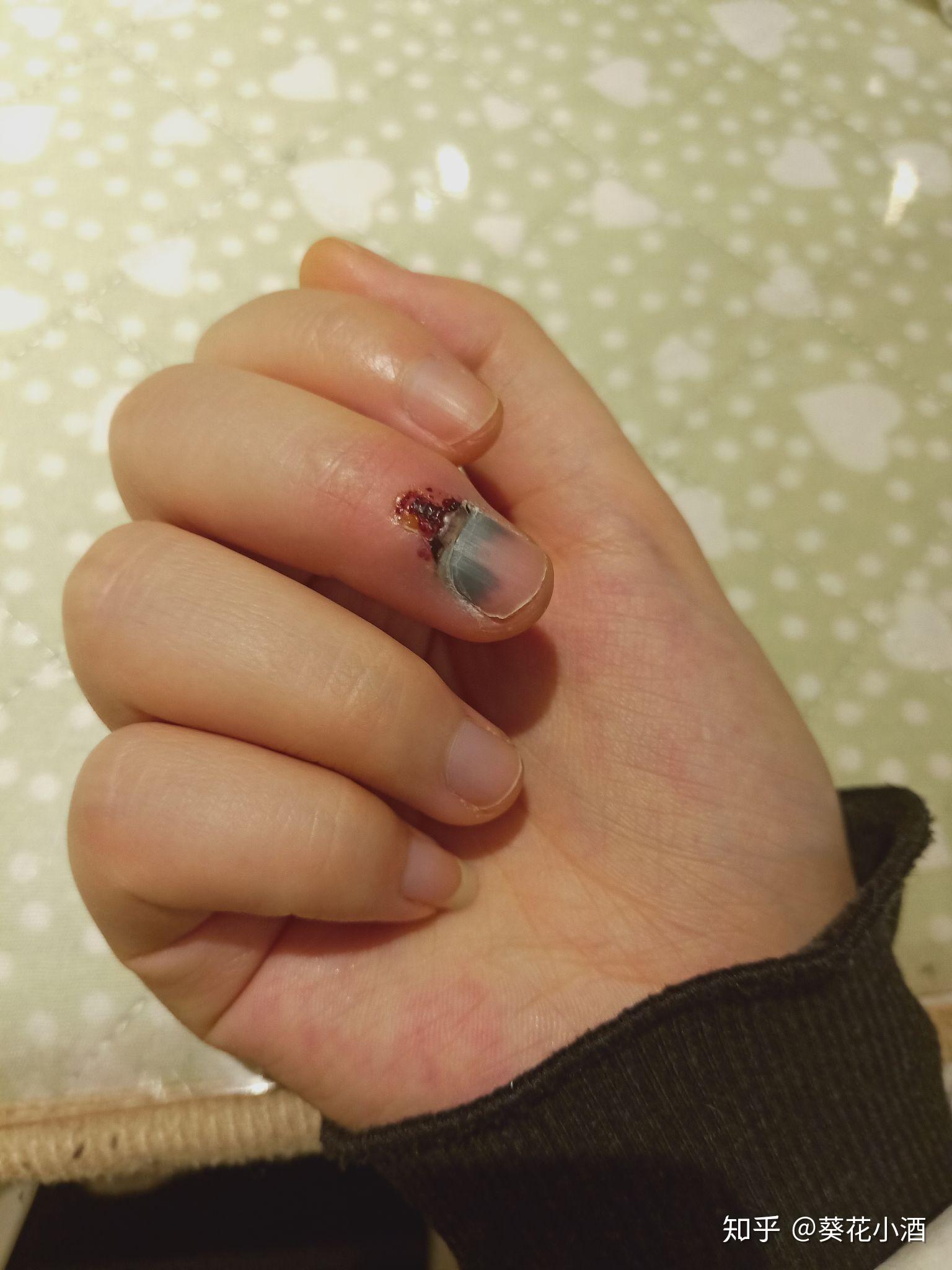 手指被门夹肿还夹出淤血是什么感受? - 知乎