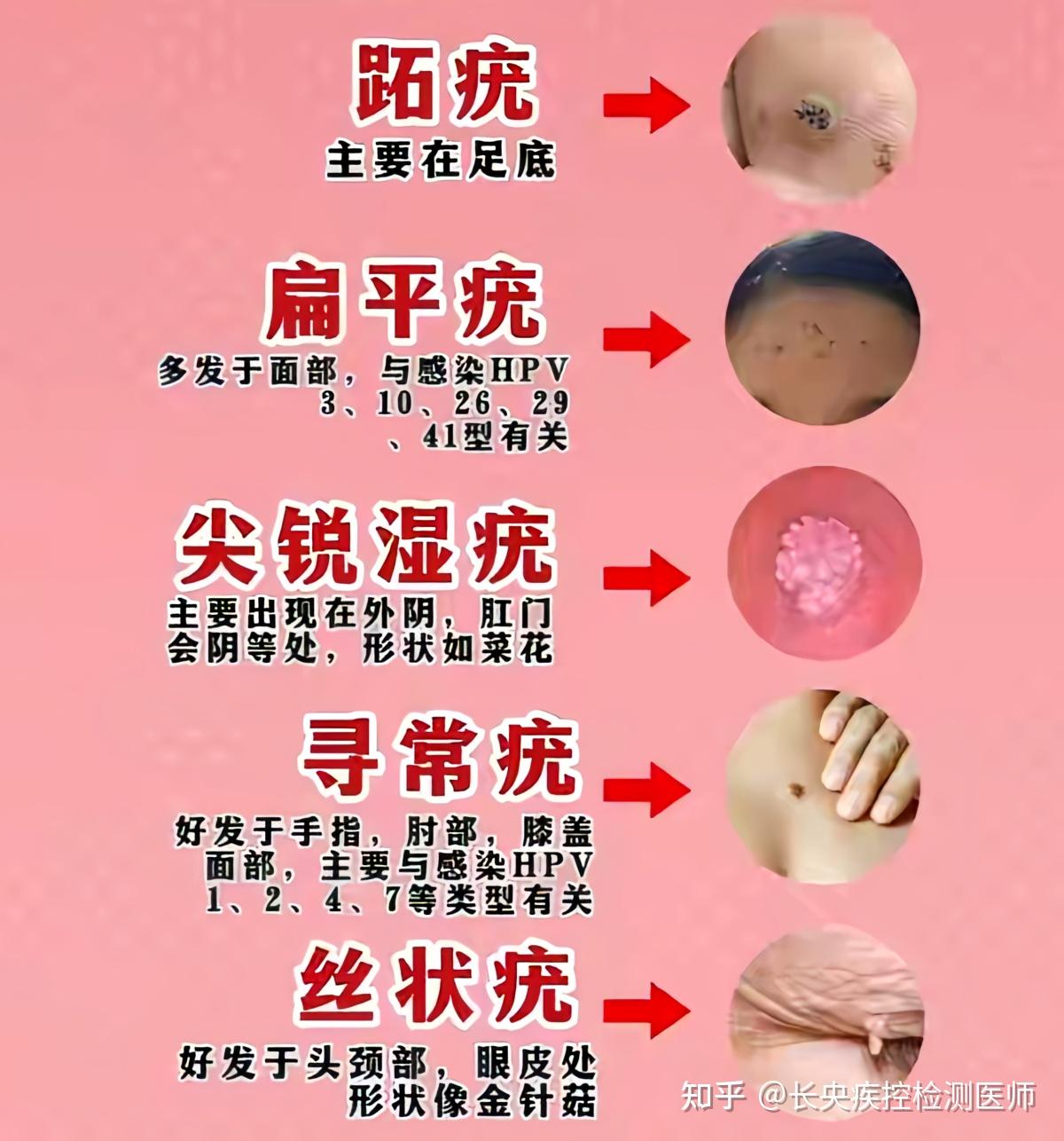 HPV能通过接吻传播吗?口腔内会不会长疣体? - 知乎