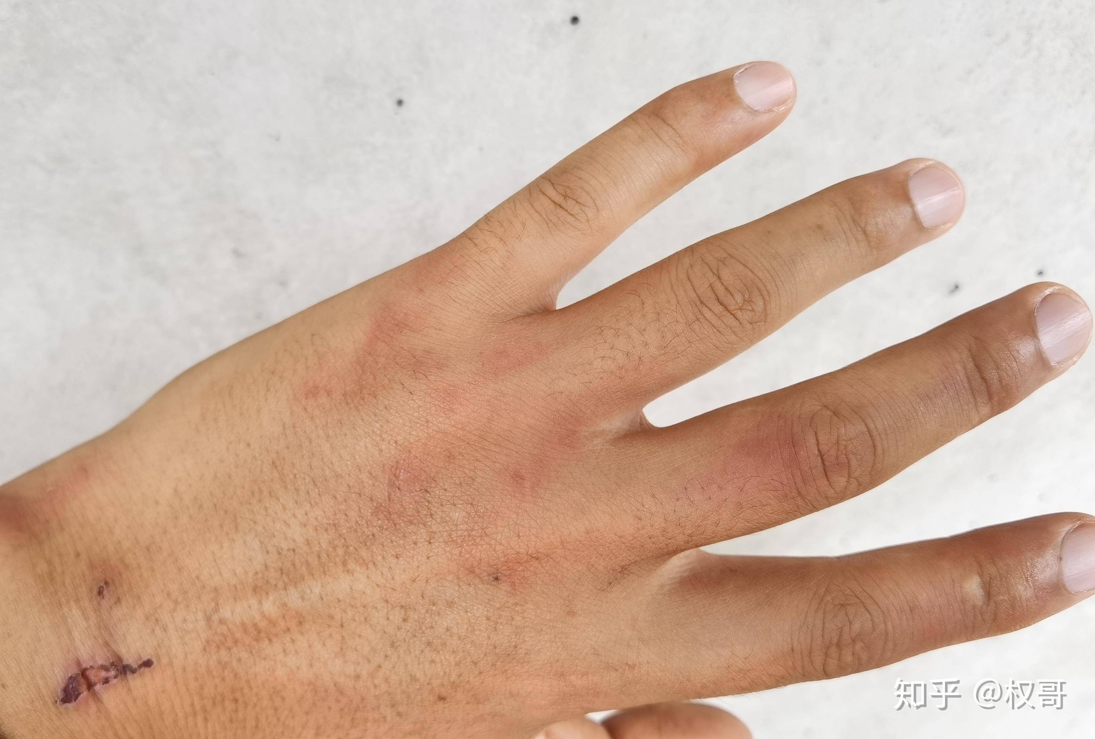 这种小黑虫是什么虫经常出现在有水相对潮湿阴暗的户外地方咬人后一大