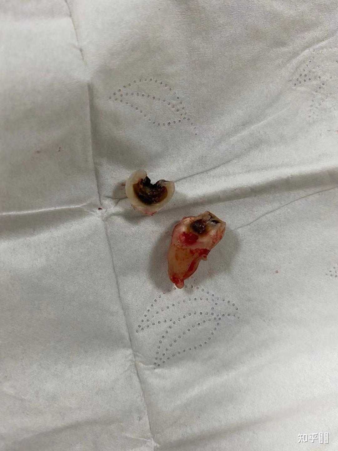 智齿需要去拔掉,但是很害怕疼,纠结要不要去拔怎么办?