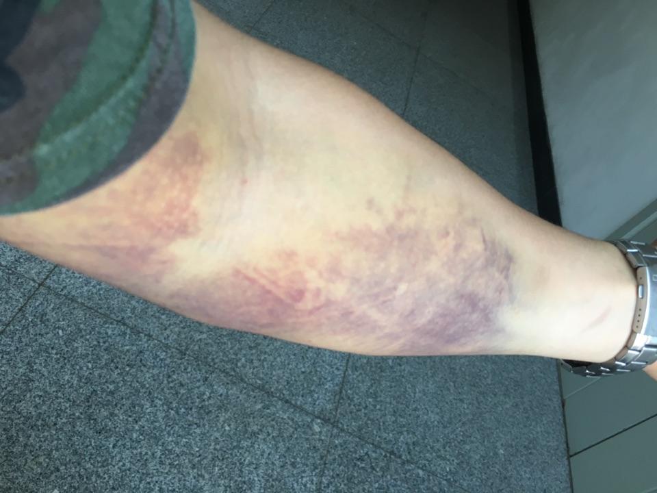 着急请问抽血后整只胳膊都又紫又青的这是怎么回事