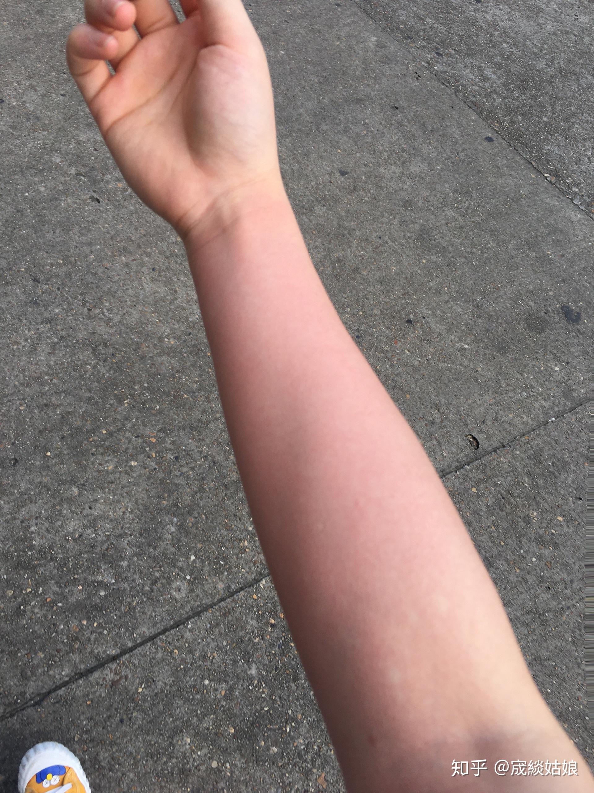 酒精过敏的人喝多了会怎么样