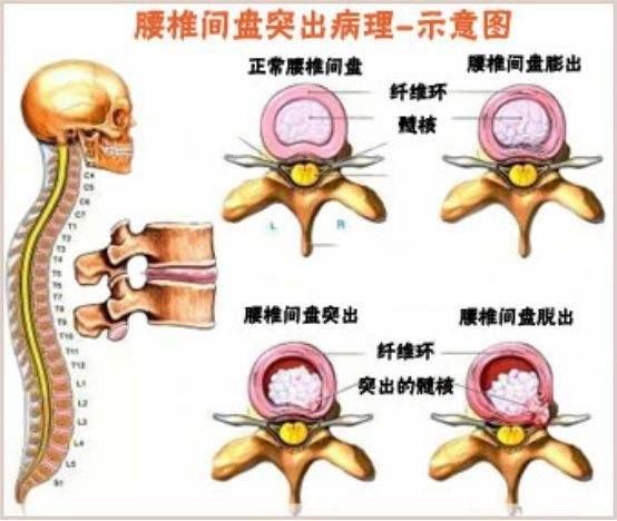 终板炎怎么治疗图片