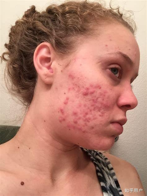 为什么欧美人不爱长痘