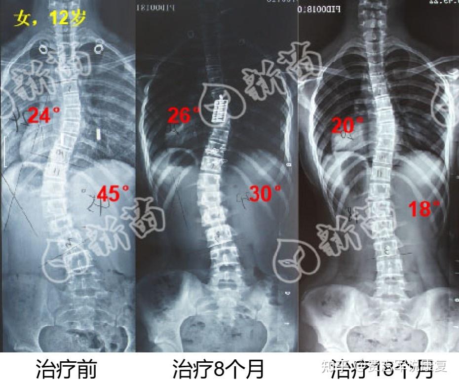 李宇春自曝患上强直性脊柱炎严重时需靠轮椅才能行走这是一种什么疾病