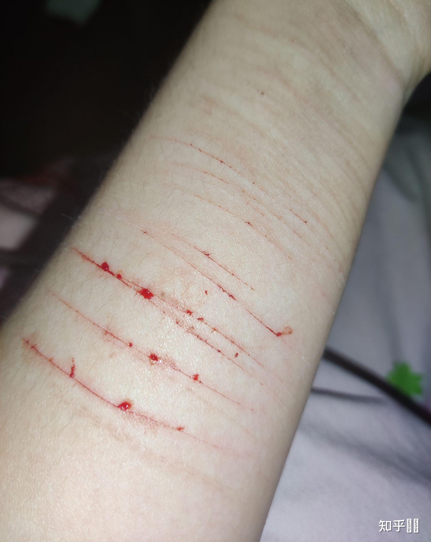 谈恋爱后开始有自残倾向