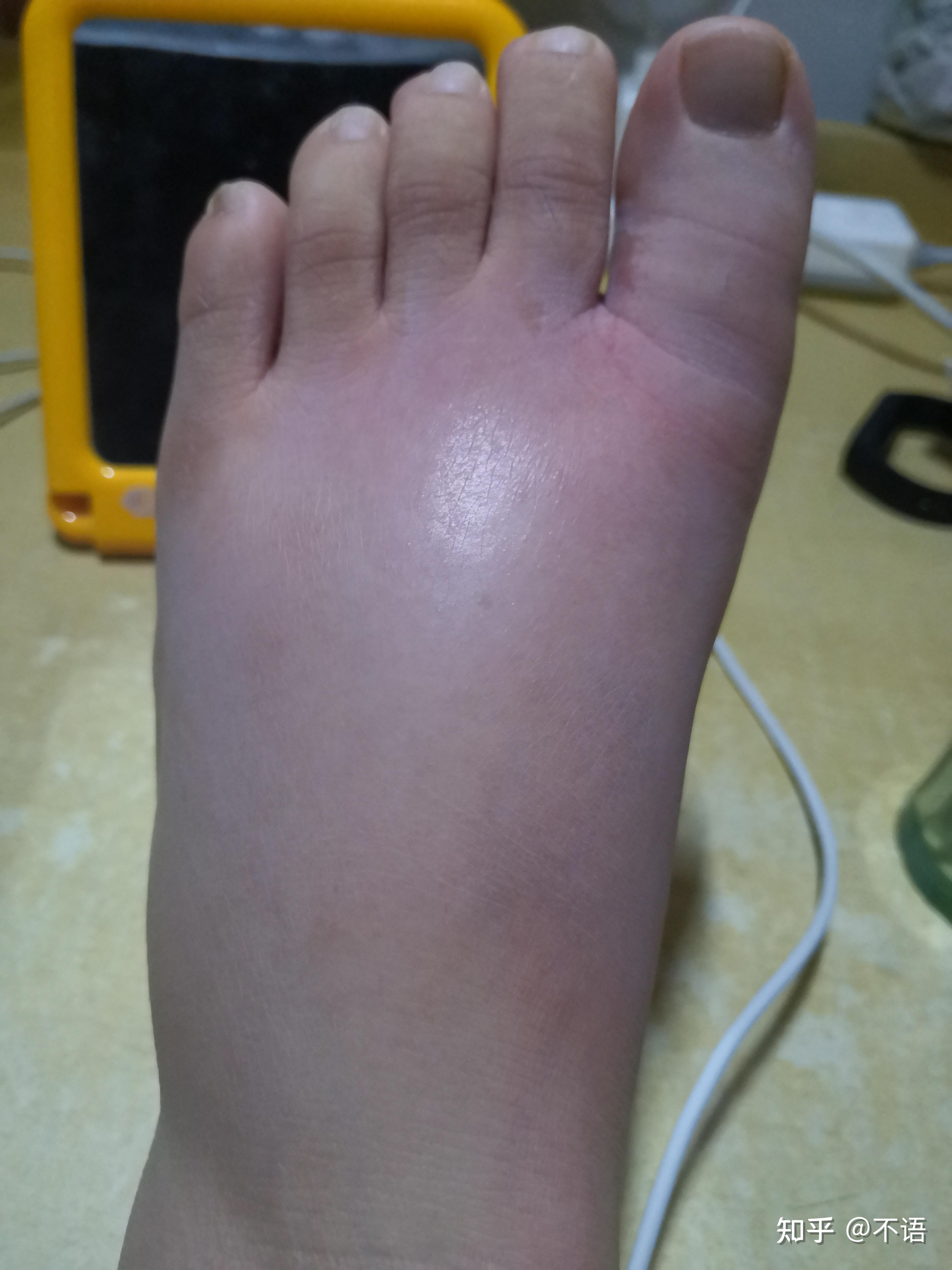 被蚂蚁咬了抠破一次然后现在又红眼痒又肿该怎么处理