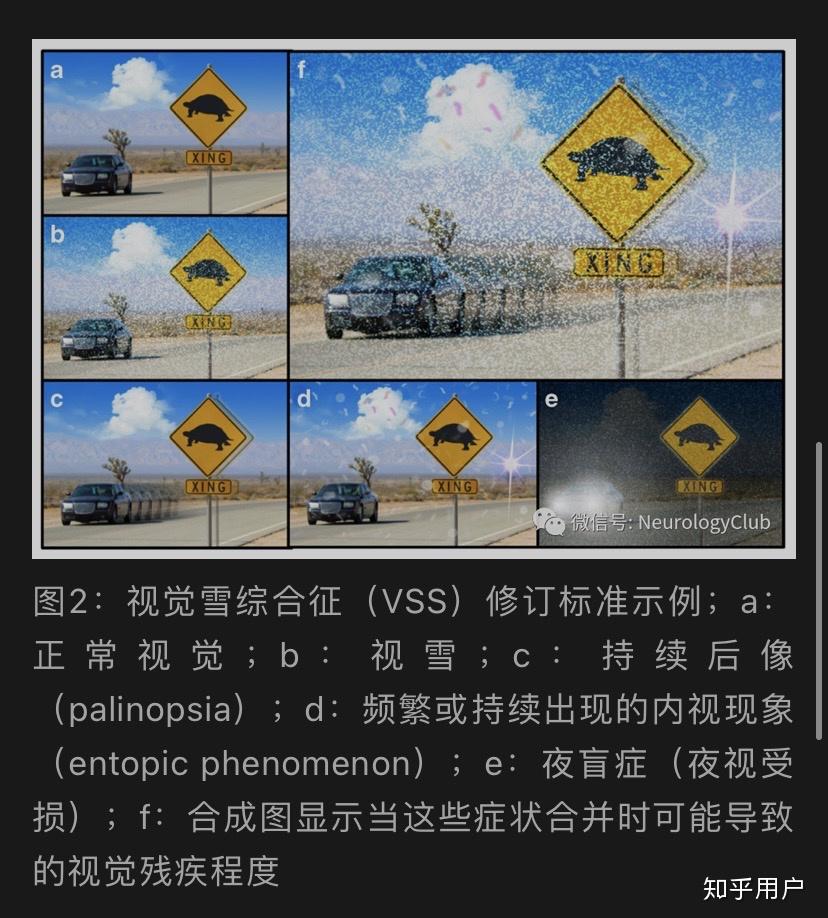 视雪综合症和视雪症有什么区别? - 知乎