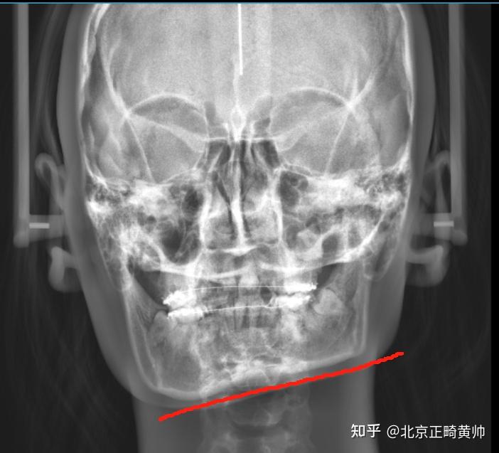 案例分享|成人骨性+牙性脸歪大小脸+重度锁颌,牙齿矫正重点分析 - 知乎