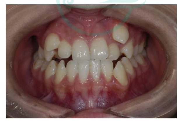 上下大牙咬合不正医生建议使用扩弓器先扩上牙再用上牙牵引下牙这个