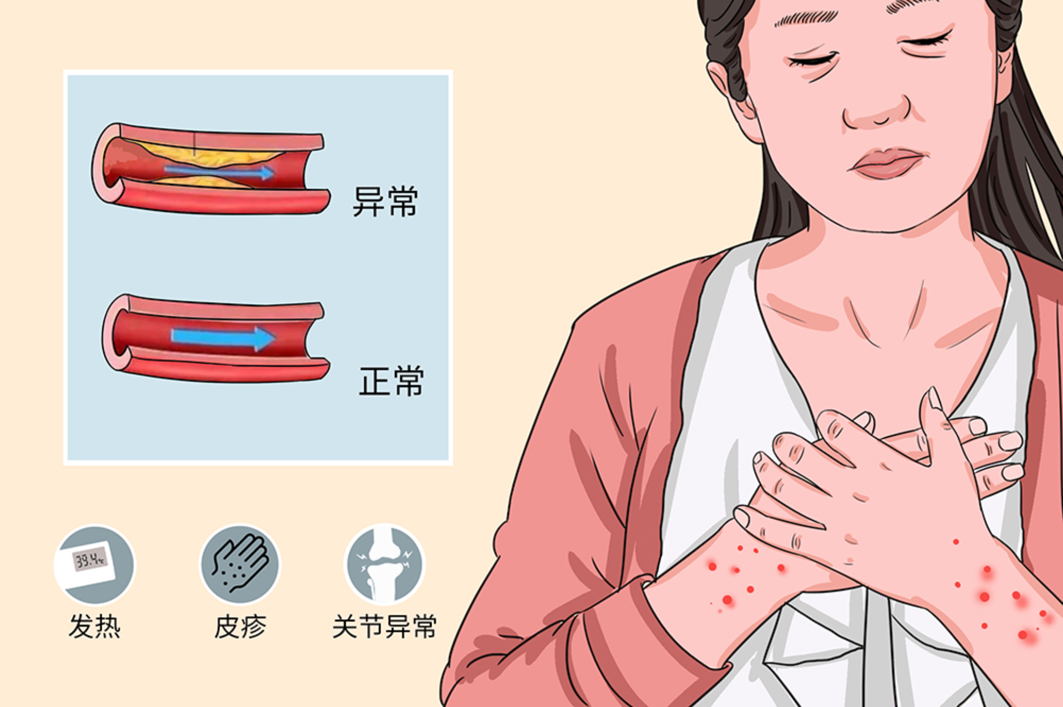 得了急性荨麻疹你们是怎么治好的