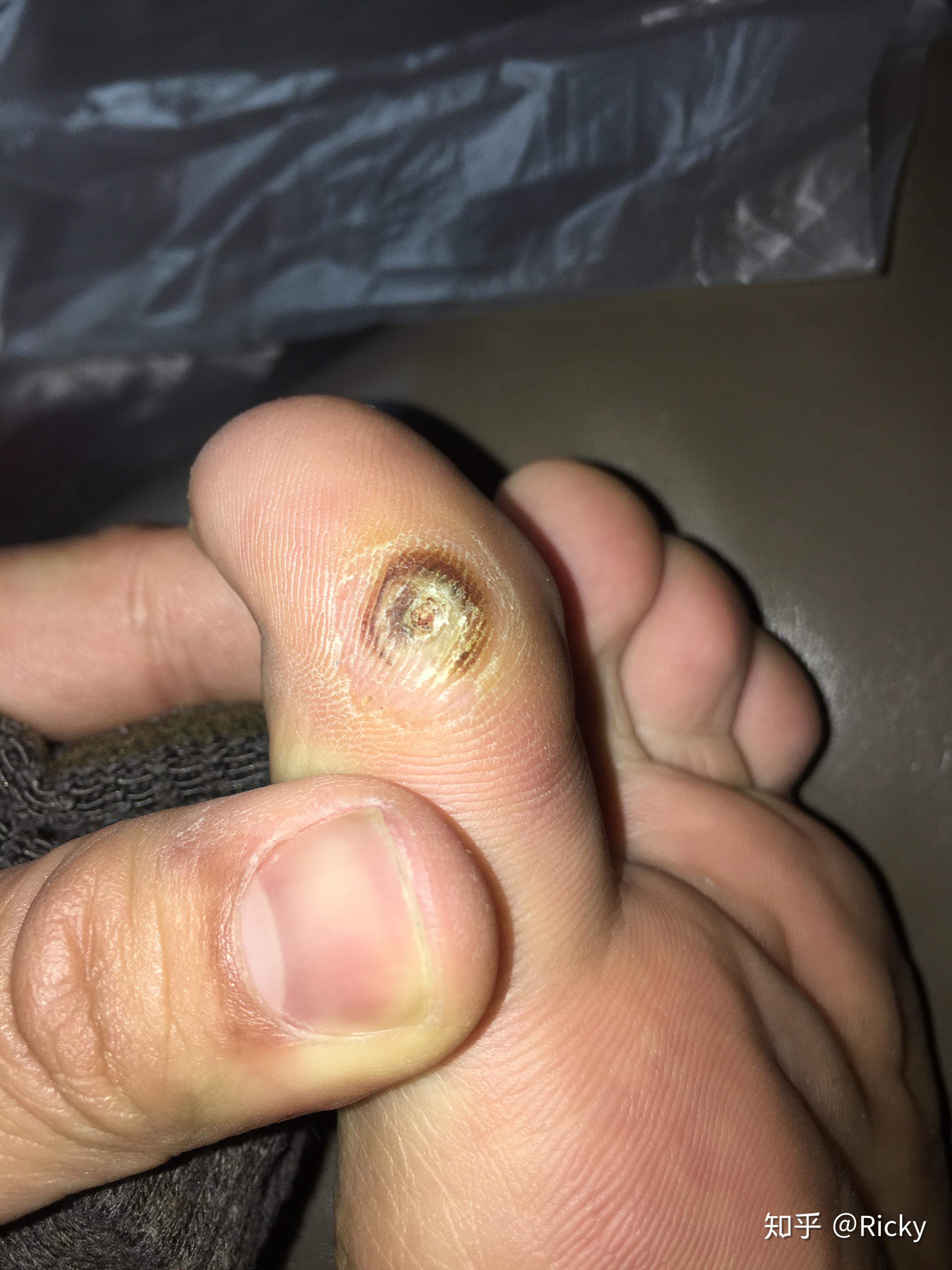 刚长出来的小跖疣怎么治?