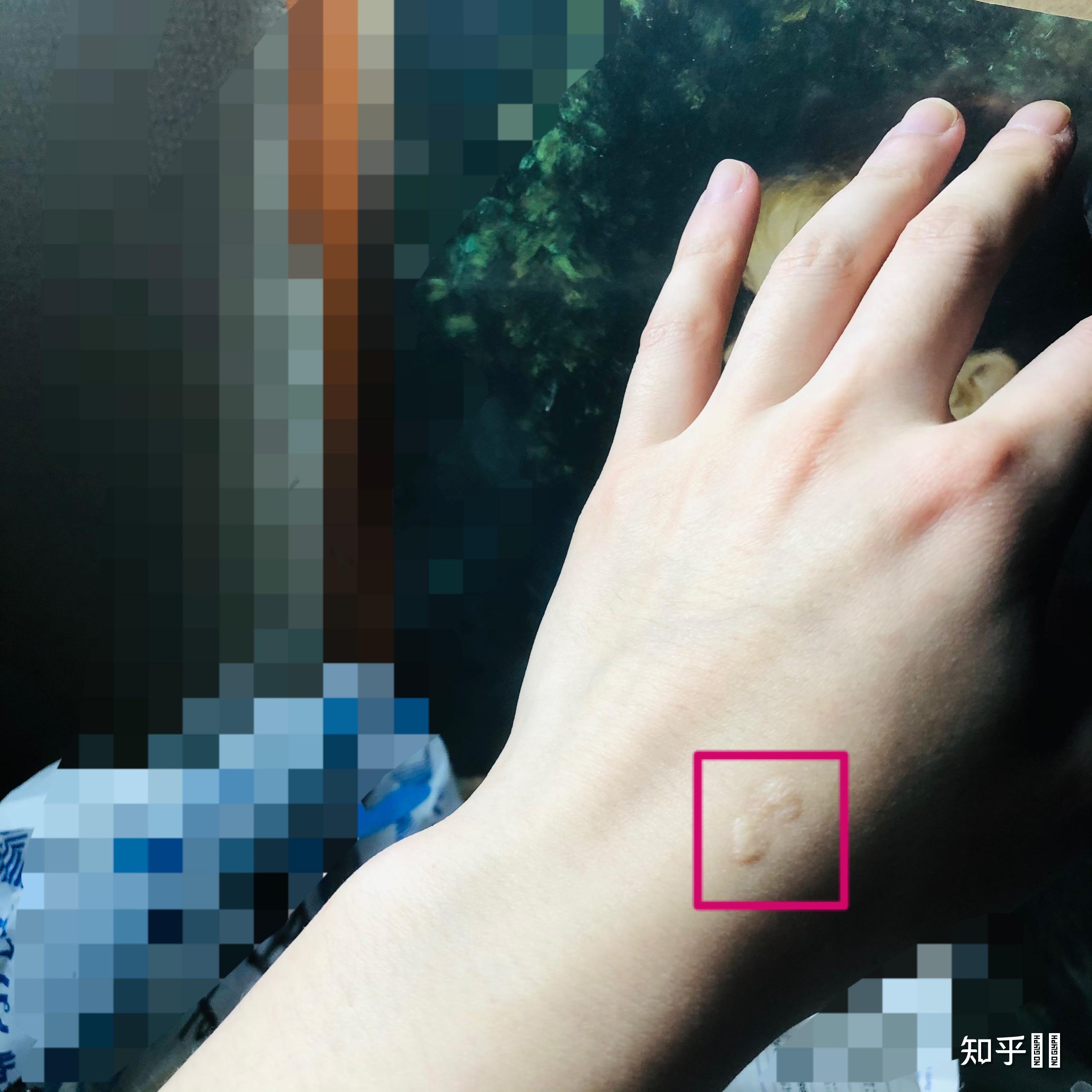 烟头烫在身上是怎样的?