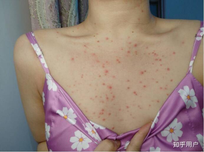 背上的痘痘怎么消去