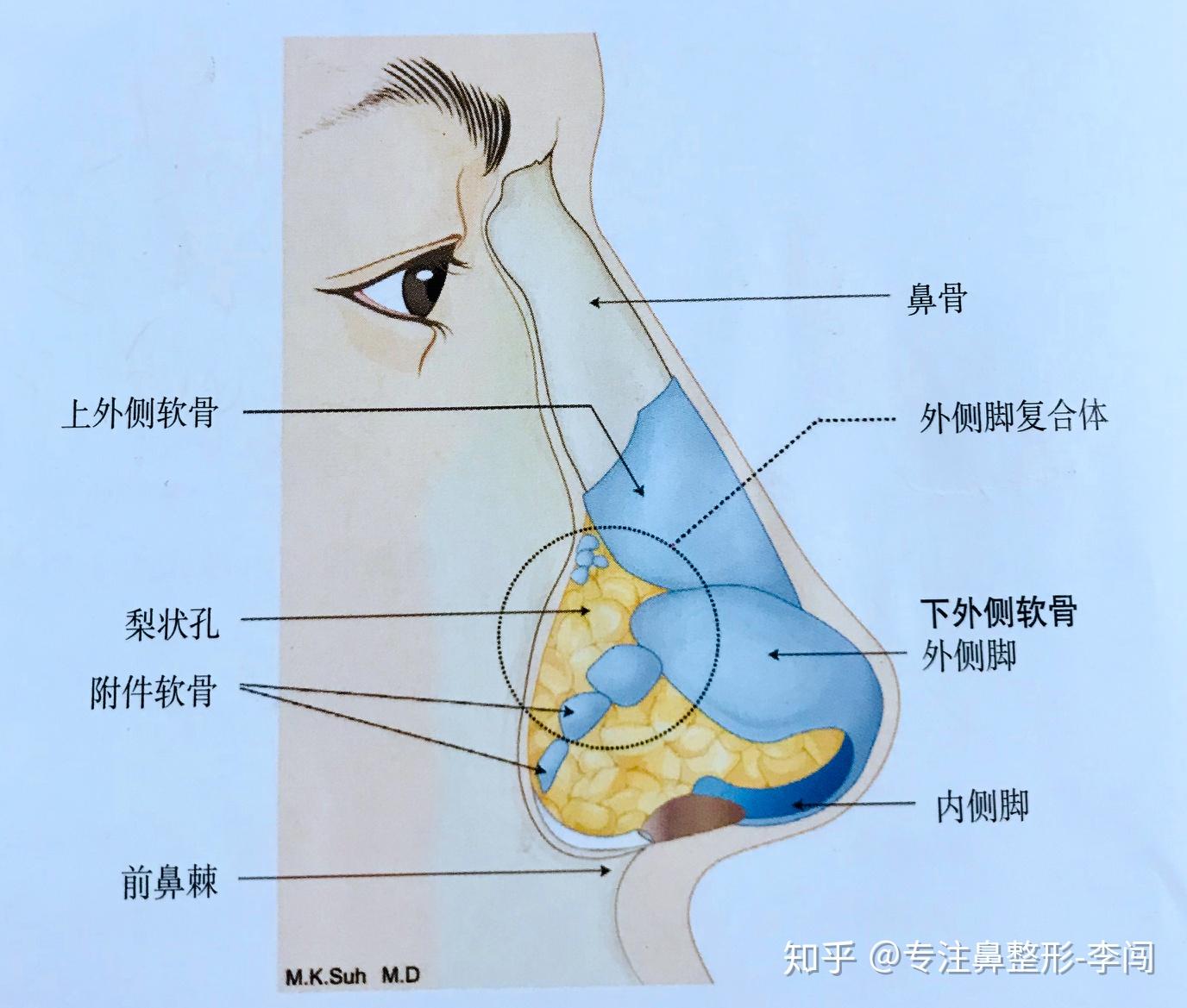 外伤导致的鼻侧软骨凹陷怎么修复? - 知乎