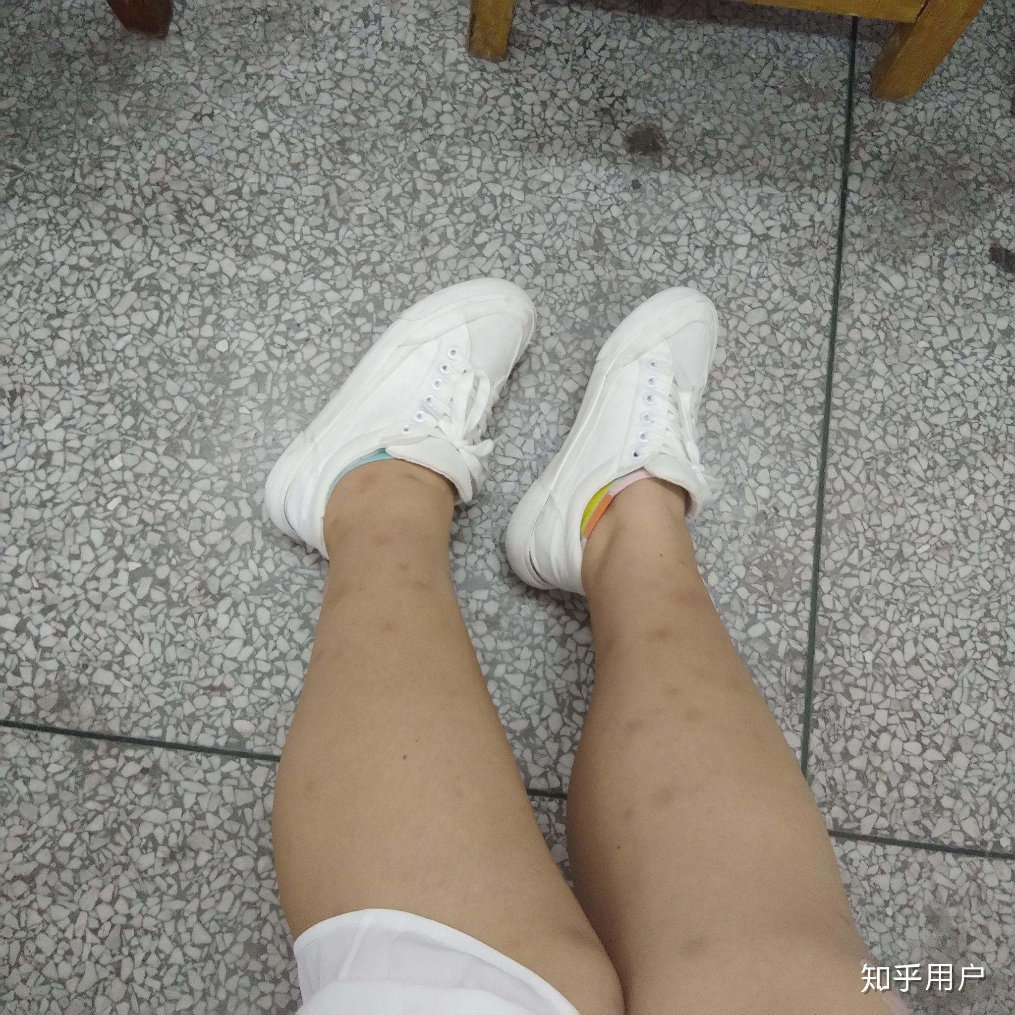 我是女生 腿上手上都有难看的疤痕 从小到大蚊子一咬就留疤 基本不敢