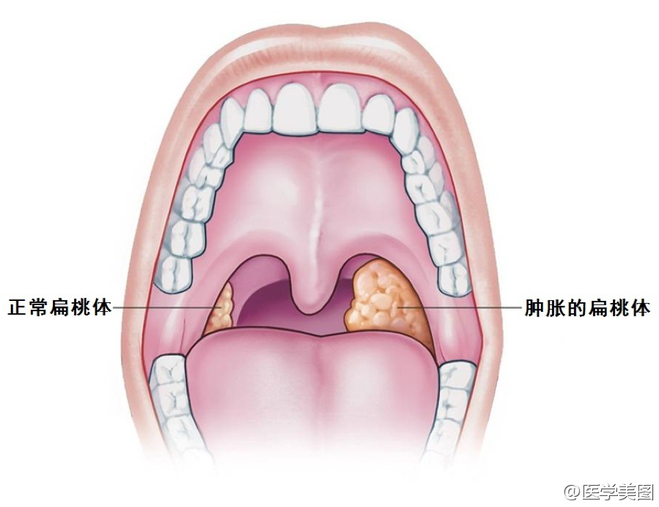 扁桃體為一卵圓形淋巴組織,位於咽部兩側舌顎弓與咽顎弓間的扁桃體窩
