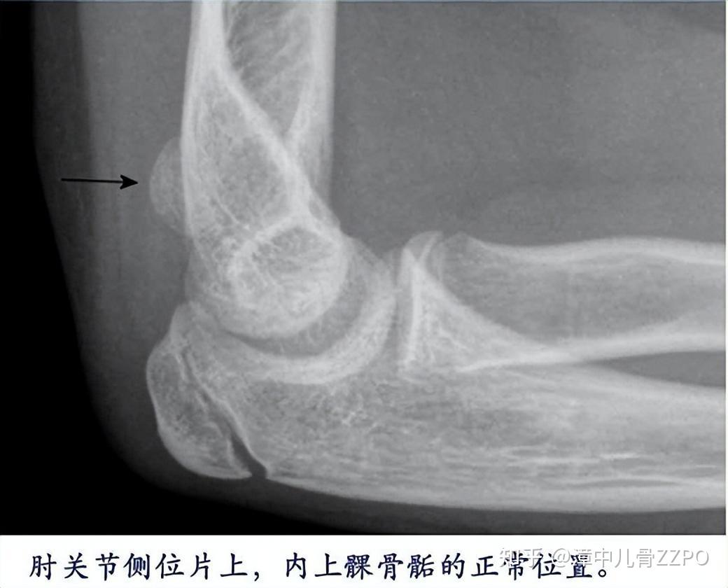 想读懂儿童肘关节x线,至少你该会这些!