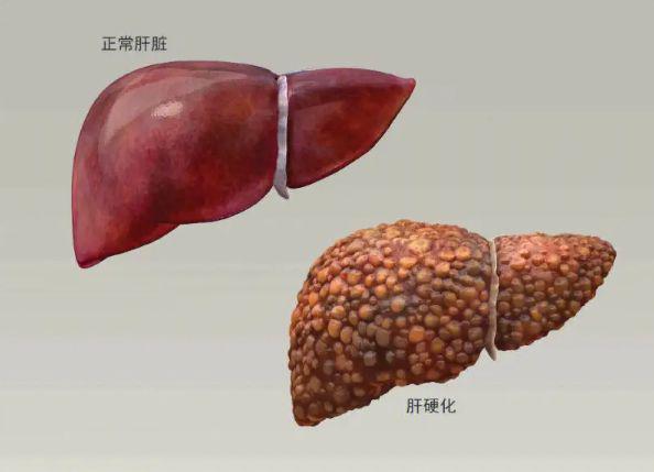 肝硬化假小叶图片图片