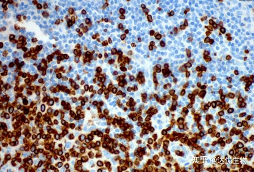 CD3、CD20…揭秘淋巴瘤免疫组化报告上的“CD家族” - 知乎
