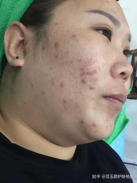豆玉颜 —— 你知道痘根是什么吗?痘根应该怎么去除? - 知乎