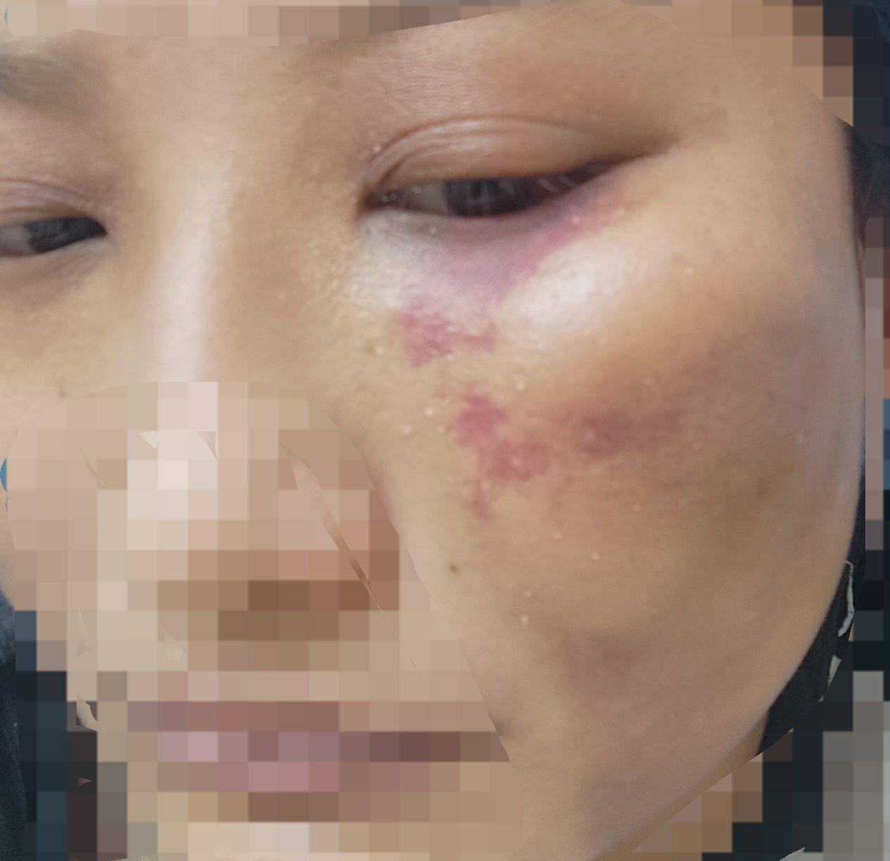 昨天下午骑车摔倒了,脸上肿了个大包,然后今天早上起来发现眼睛一周肿
