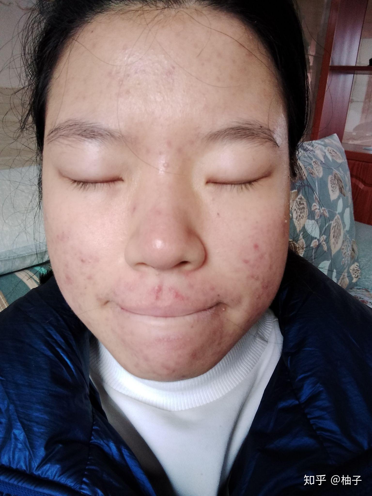 得重度痤疮是种怎样的体验? - 知乎