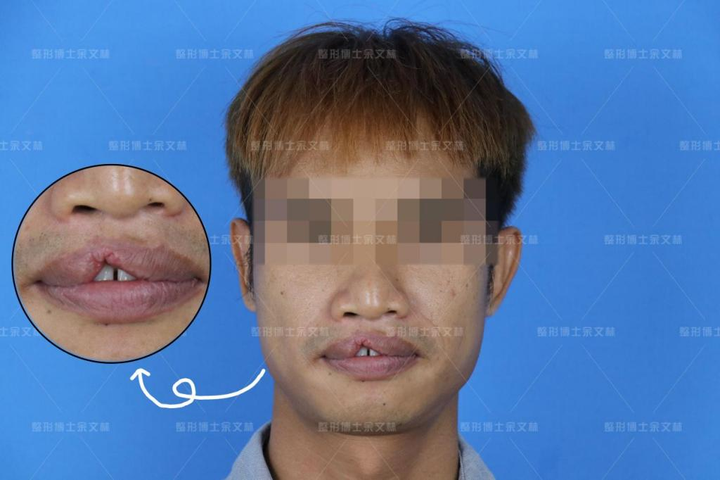 兔唇嘴巴缺了一块,说话漏风?这样修复效果很理想! - 知乎
