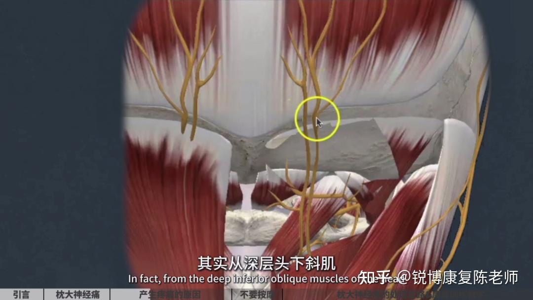 【锐博康复科普】【枕大神经痛】90%的头痛,竟与颈椎问题有关? - 知乎