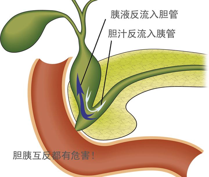 胰液返流入胆管危害巨大,其结构基础是胆胰管汇合异常 - 知乎