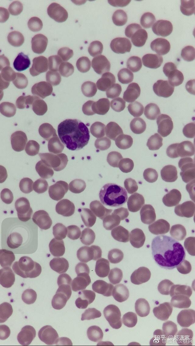淋巴细胞单核细胞图片