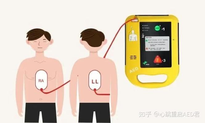 正确使用AED - 知乎