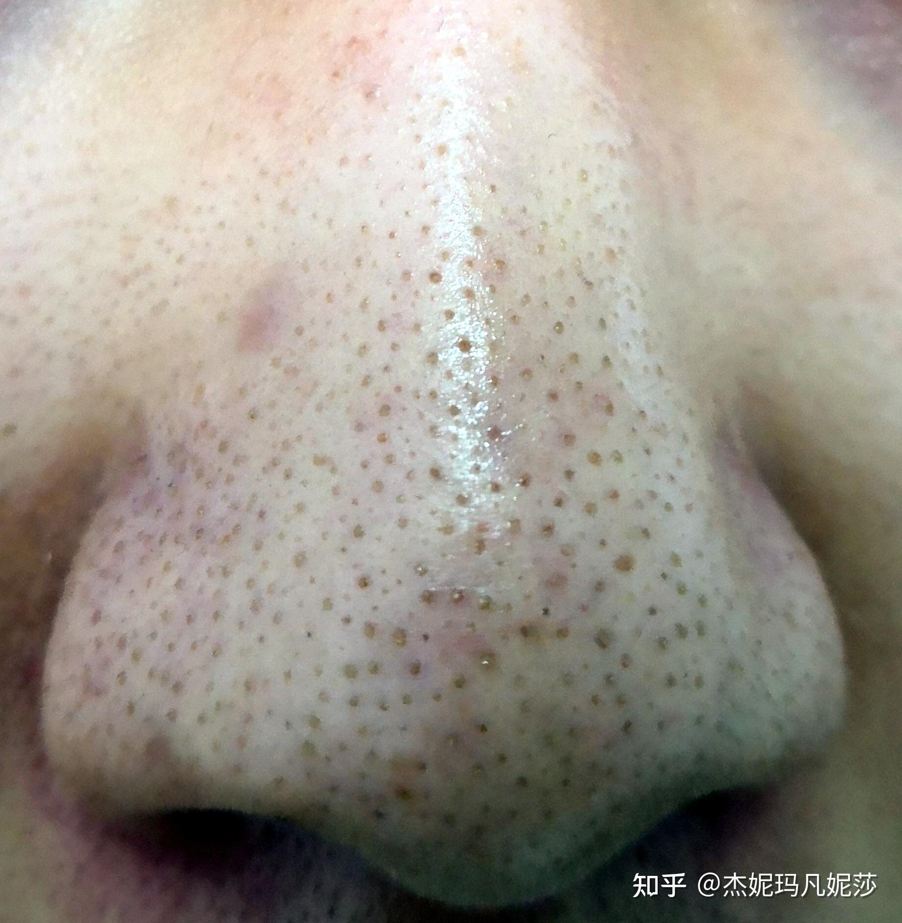 脸上毛孔粗大,应该是油性皮肤,有黑头,有时候会有痘痘有没有好用男士