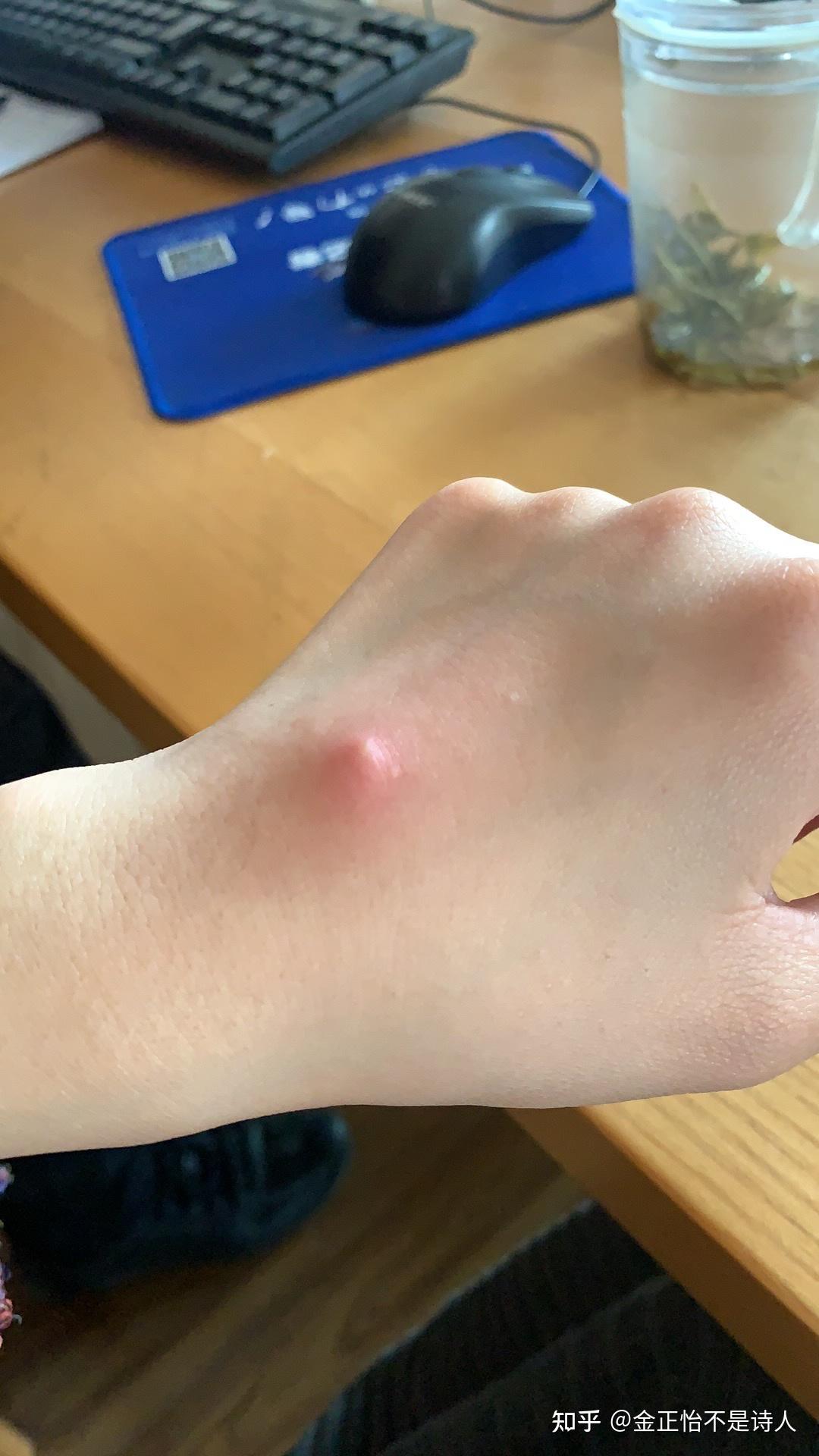 一个火疖子能大到什么地步? - 知乎