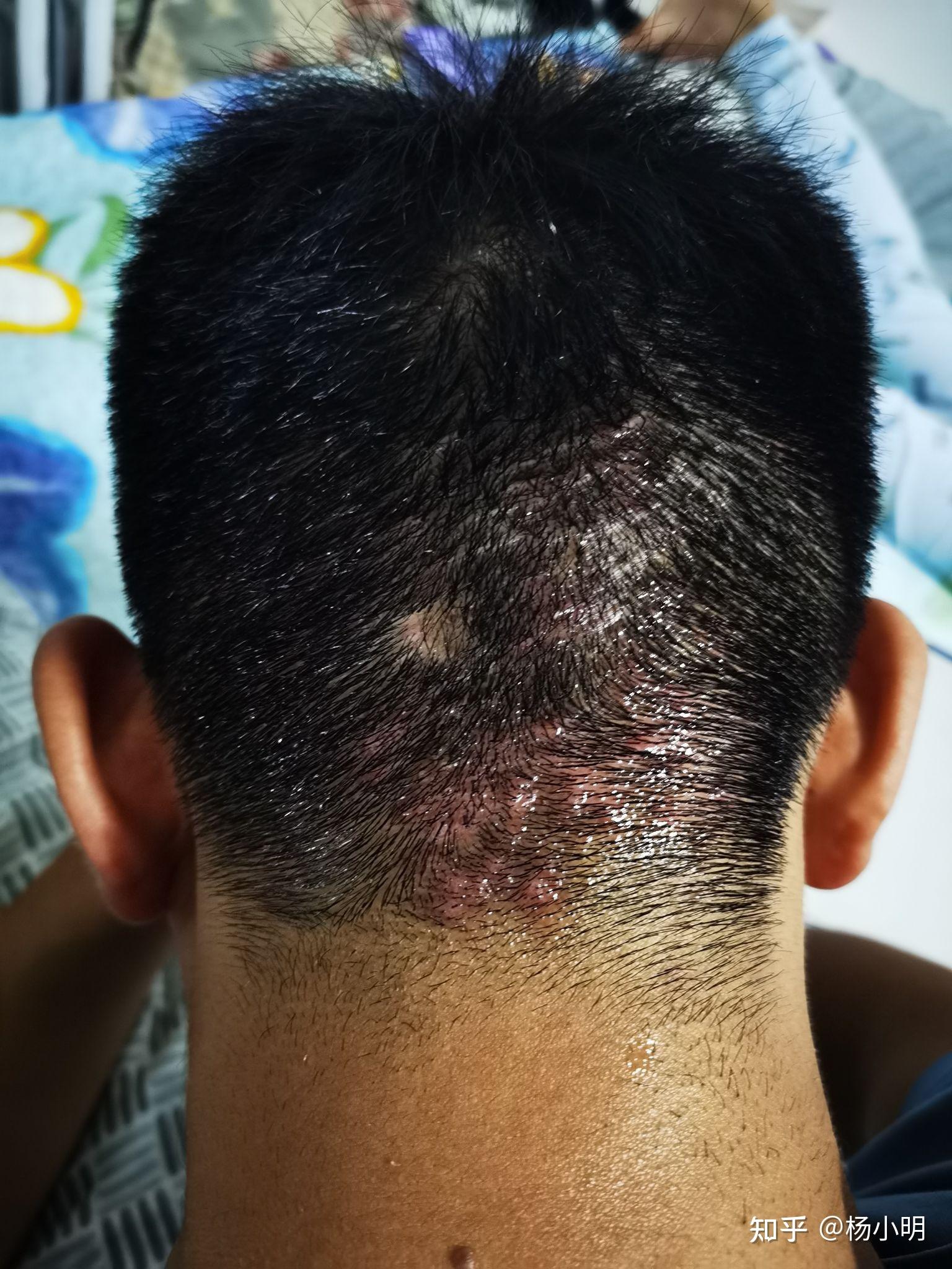 脑袋后面长了好多小疙瘩? - 知乎