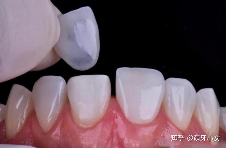 门牙形态修复 贴完瓷贴面会不会后悔?