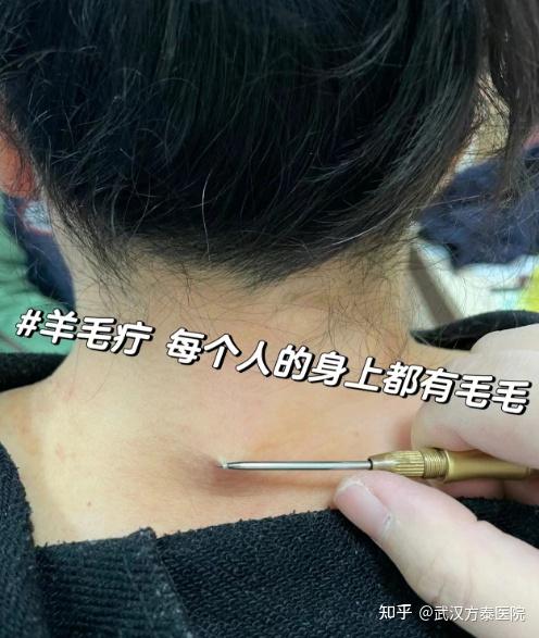 鲜有人知的传统中医外治疗法——羊毛疔挑刺法 - 知乎