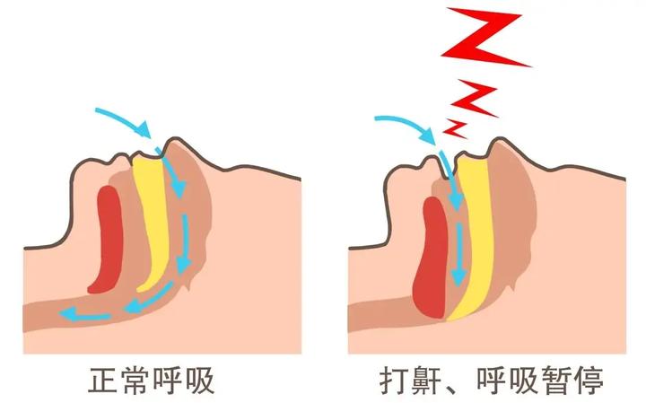 如何判断自己是否患有睡眠呼吸暂停综合征? - 知乎