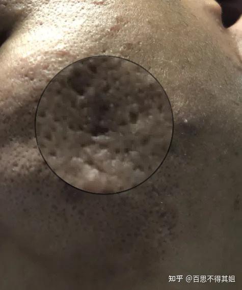 图片慎点这属于器质性毛孔粗大吗护肤品还有救不哭