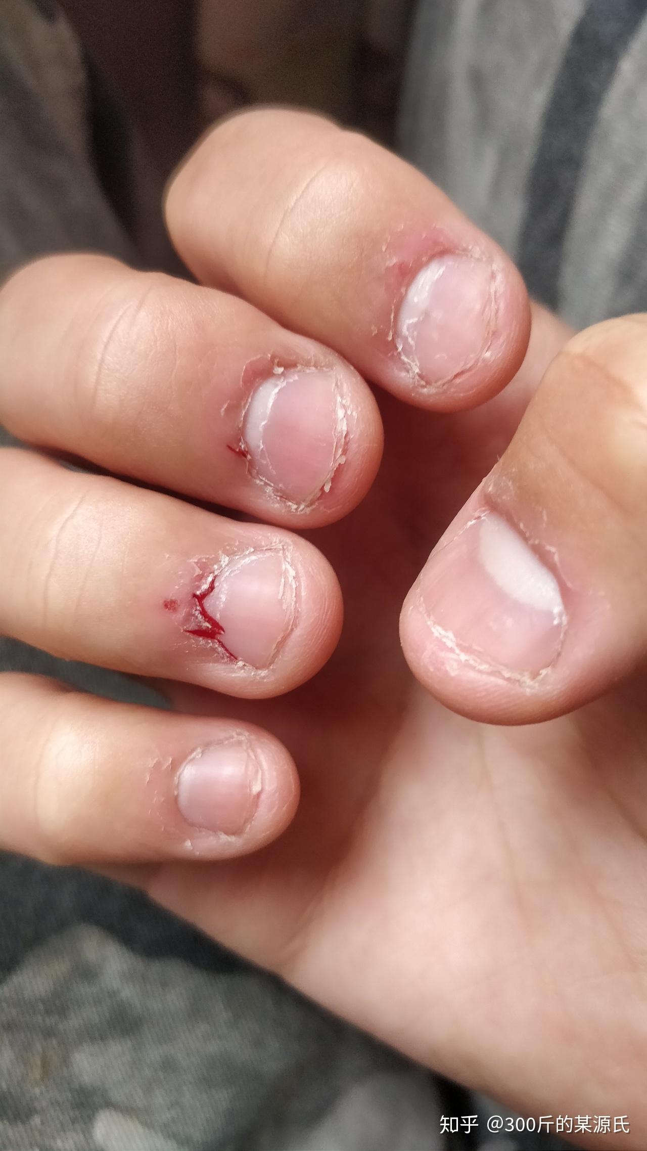 我想改掉抠手指的习惯,但是学习和紧张的时候,还是特别需要发泄焦虑的