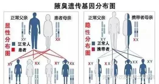 狐臭会不会隔代遗传,遗传几率怎么算?