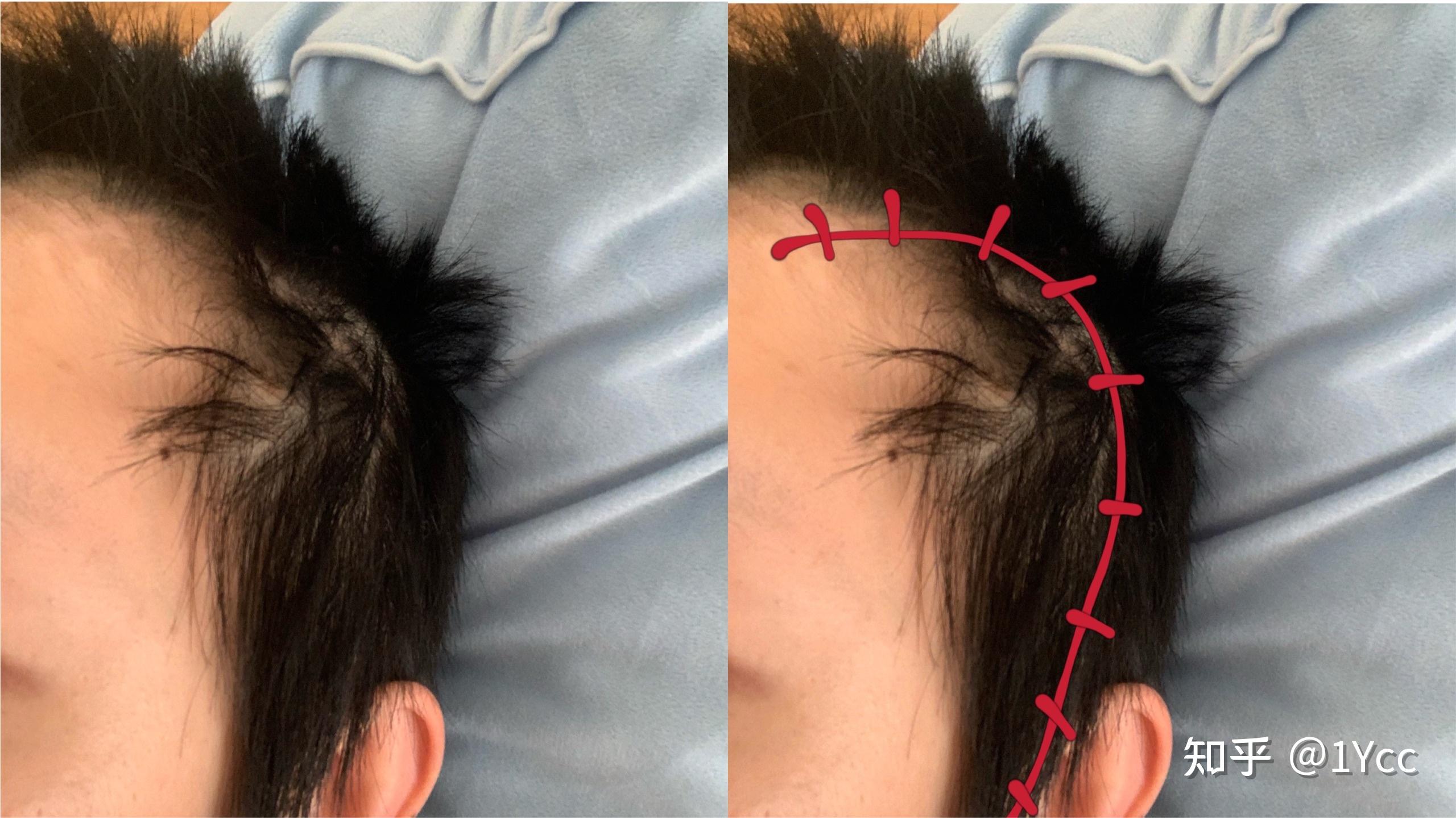 说说身边做过开颅手术的人吧.都是好的结果吗? - 知乎