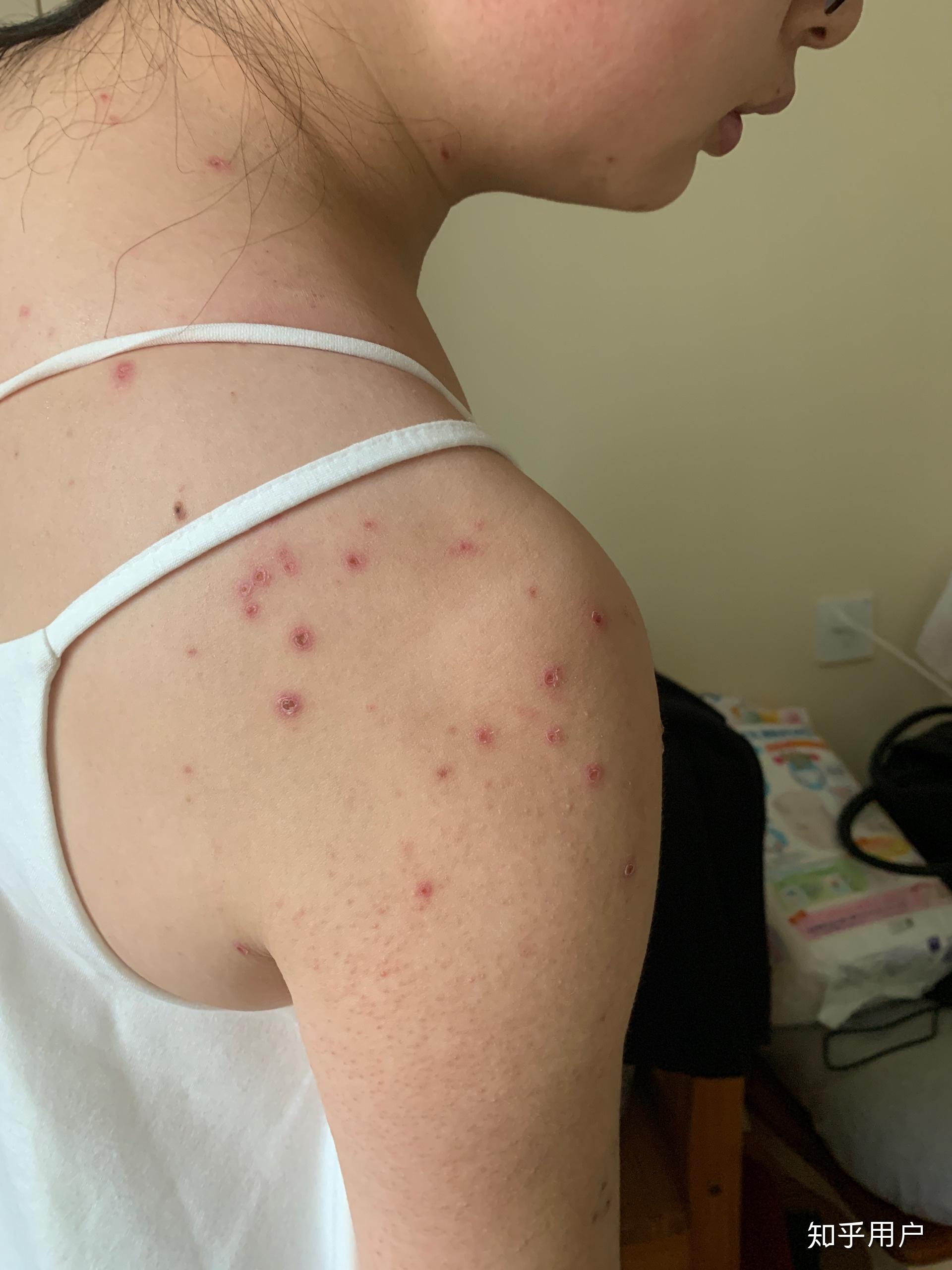成人长水痘是什么样的经历? - 知乎