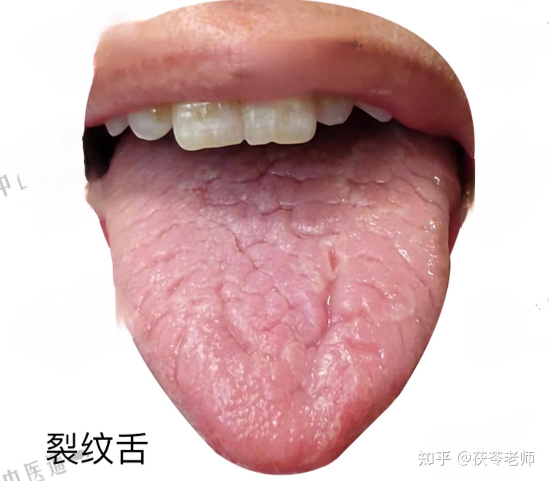 裂纹舌 - 知乎