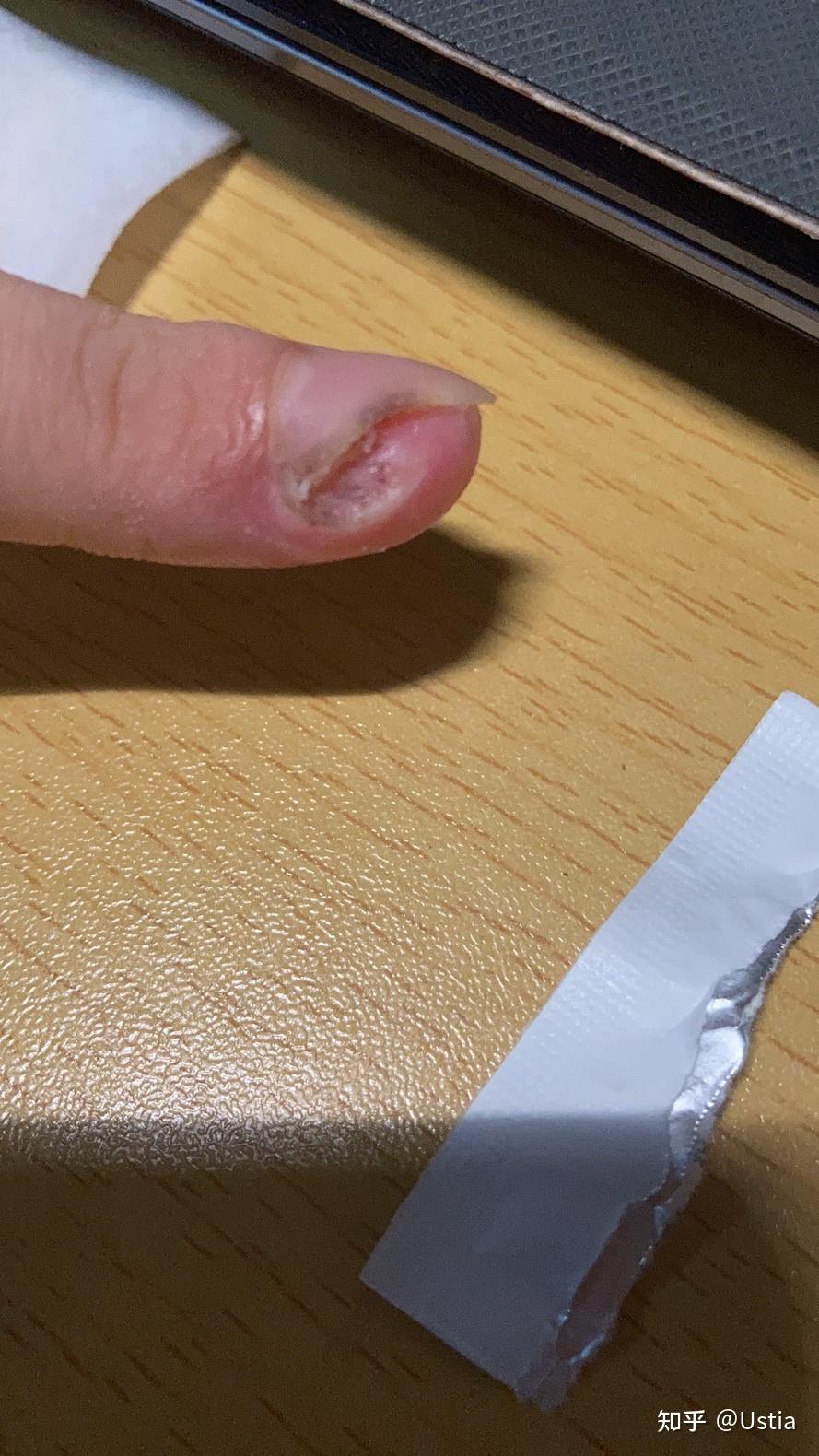 各位大神鄙人手残手指甲旁边长了死皮用指甲刀剪的时候把一些肉也剪了