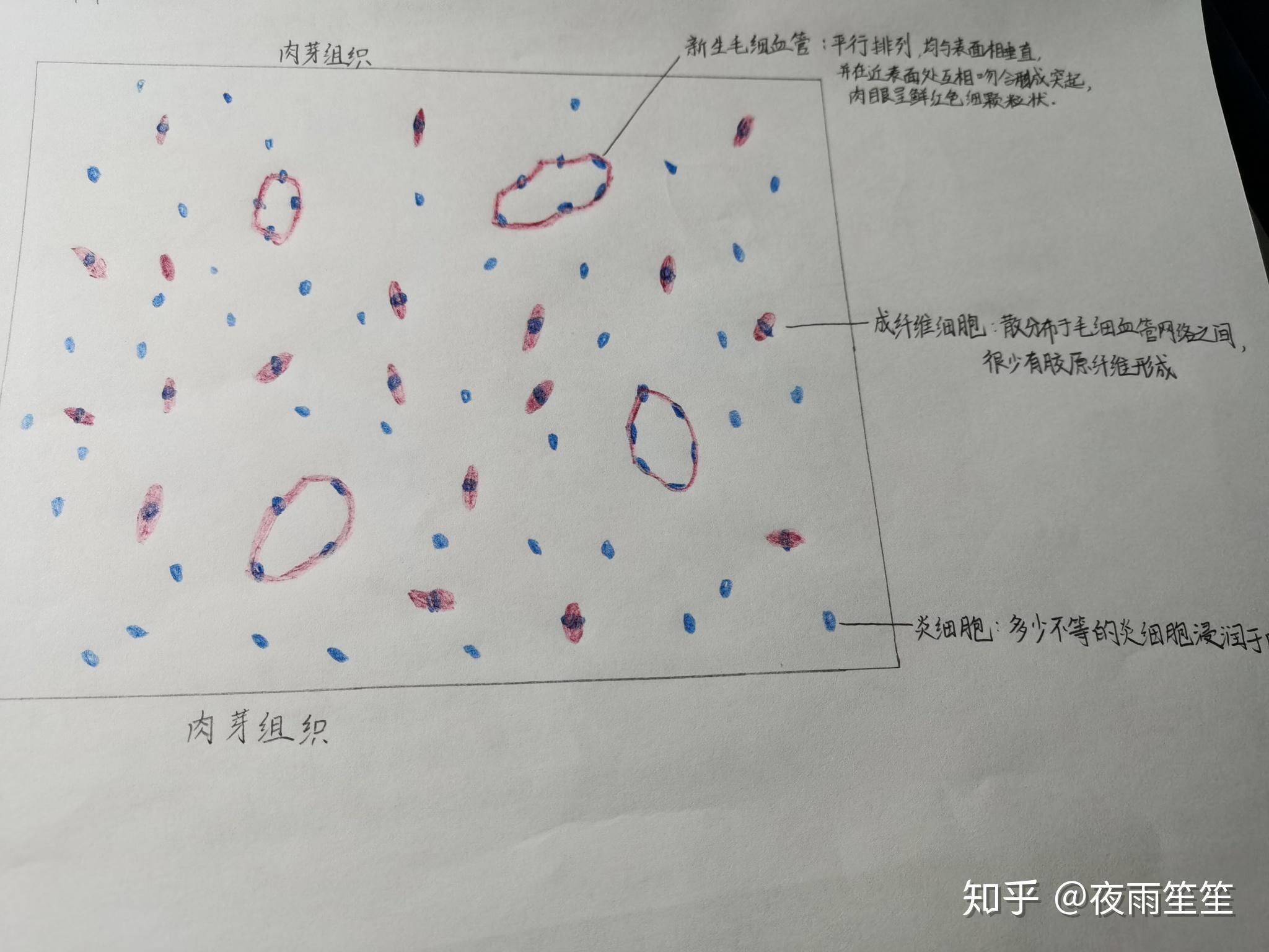 肉芽組織和血栓的紅藍鉛筆手繪圖怎麼畫救救孩子吧