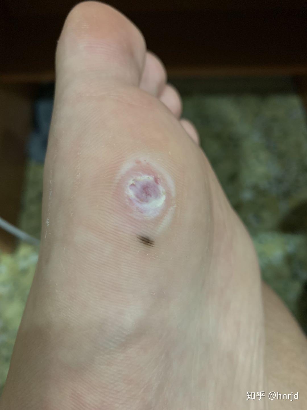 请问脚底长的这种洞洞是什么