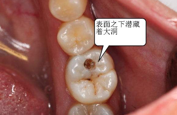 根尖周炎该怎么治疗？任由它发展下去会有什么后果？ - 知乎